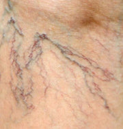 Light-Based Approach for Spider Veins Treatment with Red Light