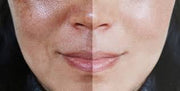 Red Light Therapy and Hyperpigmentation - Can it fade dark spots?